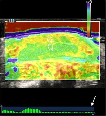 Application value of strain elastography in testicular injury assessment after torsion